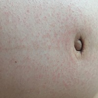 有长热痱子的宝妈吗？该怎么办？我这身上长了好多啊