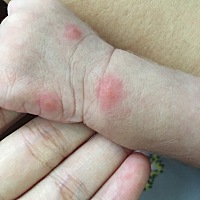 宝宝这是蚊子咬了吗？好心疼 ，可以抹什么嘛？