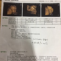 今天去做了三维，检查发现胎儿左心室点状强回声斑，要进一步做胎儿超声心动图，想问下群里姐们们这个会...