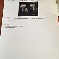 怀孕第六周，没见有胎心，发育的慢，医生叫我打打了，有经验的美女们给点意见好不好