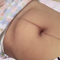 做完手术一周了，感觉为了她一切都是值得的！