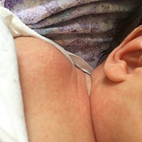 刚出生的宝宝得湿疹什么办！