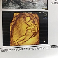 这是13周3天的NT照，怎么这么像男孩