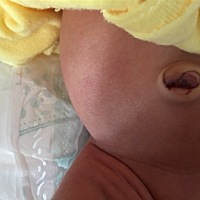 宝宝脐带脱落了有点流血怎么办？正常吗？