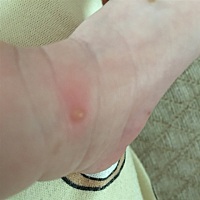 宝宝有红点，抹药之后变水泡！有知道的宝妈吗