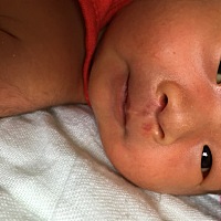 宝宝一出生鼻子下面红红的，跟毛细血管一样，有没有问题