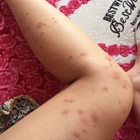 怀孕六个月全身起红疹子，出一批好一批，刚出来是大红包，过两天变小变紫。很痒会不会影响胎儿。