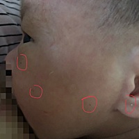 宝宝现在二十多天，脸上出现了一些类似痘痘的东西，之前是没有的，有没有宝妈知道是啥？怎么消除掉？支...