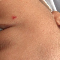 有没有宝妈知道这是什么吗，很着急，生下来没有，生下来半个月长的，现在已经一个月了还没有消，会不会...