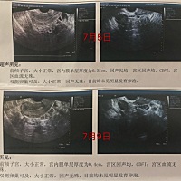 有没有小姐姐同样情况～ 用排卵试纸备孕了三个月没有情况，这个月去医院卵泡监测了，居然没有排卵～小小...