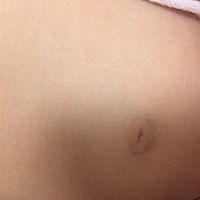 有没有女宝宝一边乳房有点秃，感觉像是发育，有没有这种情况的宝宝们，很担心。