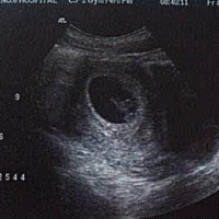 这是不是怀孕了