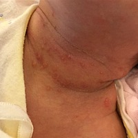 亲们，宝宝脖子上这长的是啥？会是过敏吗？还是热的呢？