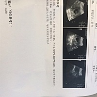 今天做的B超，我的疑问是胎芽有点大是什么情况呢？