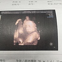 26周的四维彩超顺利通过，大家帮我看看像男孩还是女孩，今天医生说宝宝很漂亮估计应该是个小公主^_^