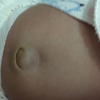 脐带脱落一个星期左右，现在看起来肚脐鼓鼓的，看起来有点肿！请问各位宝妈有没有得知的？这样有没有事的？