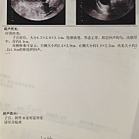 备孕中。排卵期的三张彩超单子，求大神告诉最后一张什么意思啊