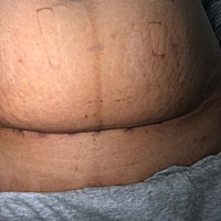 剖腹产十天后的疤痕，感觉不想再怀孕了，你们的伤口都是怎样的呀