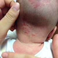 宝宝长湿疹了怎么办