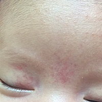 宝妈们打扰一下 我家宝宝这眉心和右上眼皮生下来就红红的 有知道的这严重吗 现在已经39天了 还是没有消...
