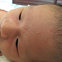 婴儿痤疮…咋整好？愁坏妈咪了🤦🏻‍♀️有和我家宝贝一样的么🤦🏻‍♀️