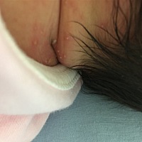 3天的宝宝 脖子后面长了好多粉刺 脂肪粒似的白泡  能挤出东西来 有同款宝宝没 怎么办 在线等