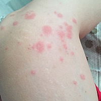 坐月子期间有宝妈长这个东西吗？很痒，越抓越大个，好烦人