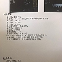 脐绕颈俩周😔要怎么办 好担心 睡不着觉