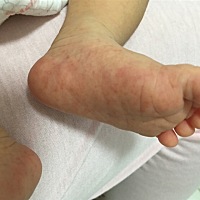 新生儿16天脚上起了好多红点，是怎么了