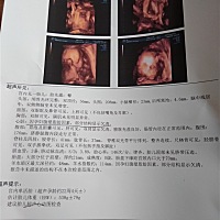 昨天做的四维彩超，感觉宝宝好丑哦😀😀医生还说我脂肪太厚看不清楚心脏，准备要去做心脏彩超。一个...