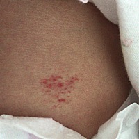 有宝妈知道肚子上这血红的是什么吗？