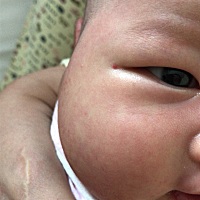 这么小的血管瘤有没有人知道用药物或是物理性的治疗方法