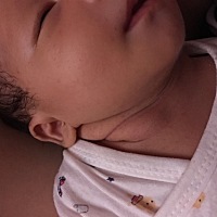 有没有宝妈小孩是斜劲的。一般要多久才能好？