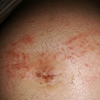 最近肚子的毛出了很多，之前都没有的，也不知道男孩女孩，请问有没有怀孕七个月肚子上会长湿疹，在腰部...