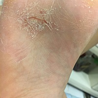 孕23周加5天了 右脚奇痒无比 又脱皮 每次痒 一抓 就会开裂 好痛 左脚从来没有过任何症状  除了擦酒精别...