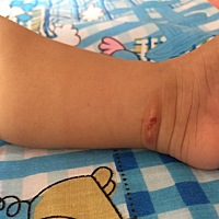 好心疼宝宝的左脚脚踝，谁能告诉我这长的是什么东西？