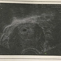 大姨妈推迟了三四天，用早早孕测了之后阳性，去医院检查医生让做阴超排出宫外孕，排除了宫外孕，但是没...