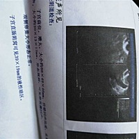 有没有类似的孕妈啊？好担心，医生说宝宝在宫角如果要可能会大出血，而且宝宝还没有胎心怎么办，6月6日...