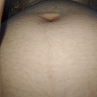 请问医生这是妊娠线吗？