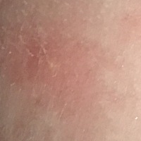 请问一下宝宝脸上身上有这个脓包一样的东西而且越来越严重 这是怎么回事