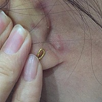 这是什么鬼？毛囊炎么？之前一直不痛不痒，最近好像长大了。熬夜了总要还的。姐妹们备孕是不是都锻炼身...