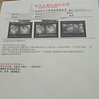 有专业人士看看是不是宫外孕，孕酮在降，hcg翻的不是那么好