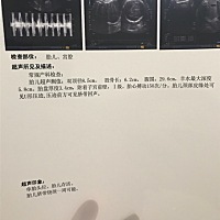 看B超猜猜看.男宝女宝