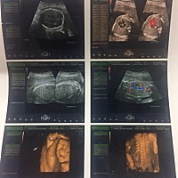 胎儿偏小3周，至少一直孕吐，吃不下！现在已经6个月了，胎动频繁，不知道啥问题？