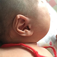 宝宝耳朵这样，两边的都这样，是不是需要矫正啊