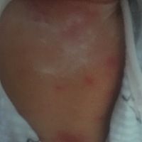 才出生几天的宝宝身上长了这么多红疙瘩。宝宝身上痒要抓怎么办？有没有宝妈有过类似的情况。好担心啊