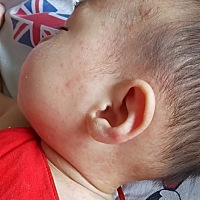 八个月  脸上脖子上都是红疙瘩 去医院有说热痱子有说湿疹 用药膏不见好，求有经验的宝妈妈告诉告诉怎么...