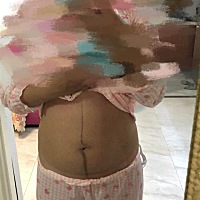 绑了5天收复带，热的要死。生完双胞胎姐妹的肚子，俩个崽加一起8.5斤。没有涂抹任何护肤品。