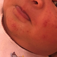 宝宝14天啦，一个多星期前脸上长了红色带白顶的痘痘，以为是湿疹。去医院医生说是因为母亲体制问题引起...