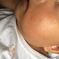 3个月多宝宝反复过敏怎么办啊？好了一点又出